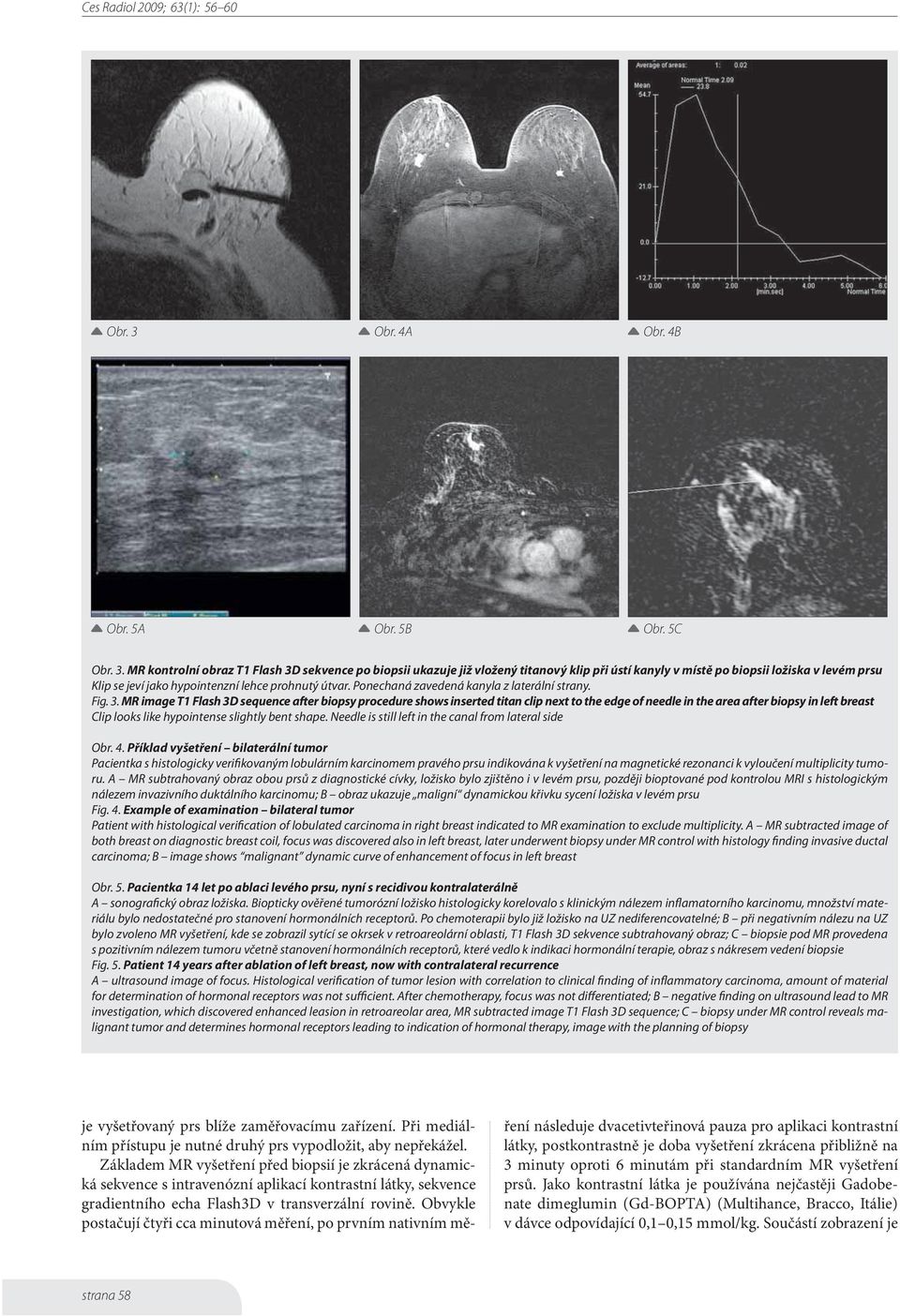 MR kontrolní obraz T1 Flash 3D sekvence po biopsii ukazuje již vložený titanový klip při ústí kanyly v místě po biopsii ložiska v levém prsu Klip se jeví jako hypointenzní lehce prohnutý útvar.