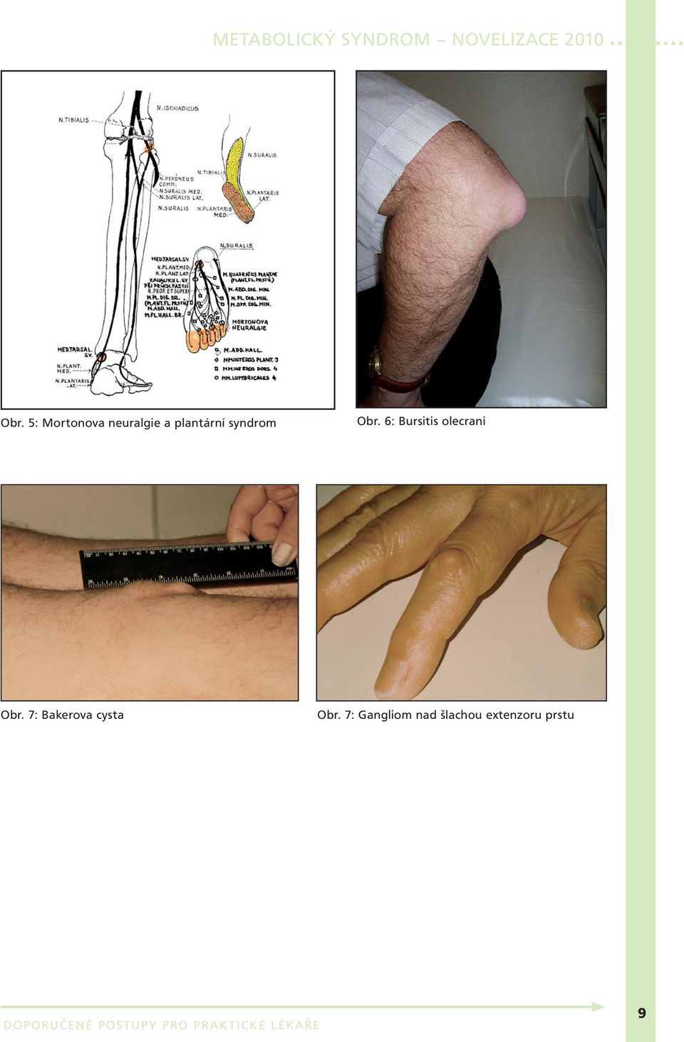 6: Bursitis olecrani Obr.