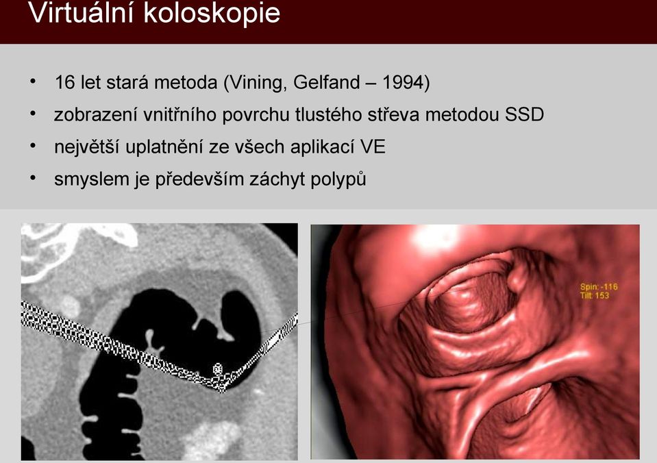 povrchu tlustého střeva metodou SSD největší