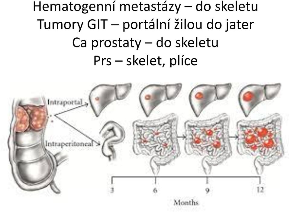 portální žilou do jater Ca