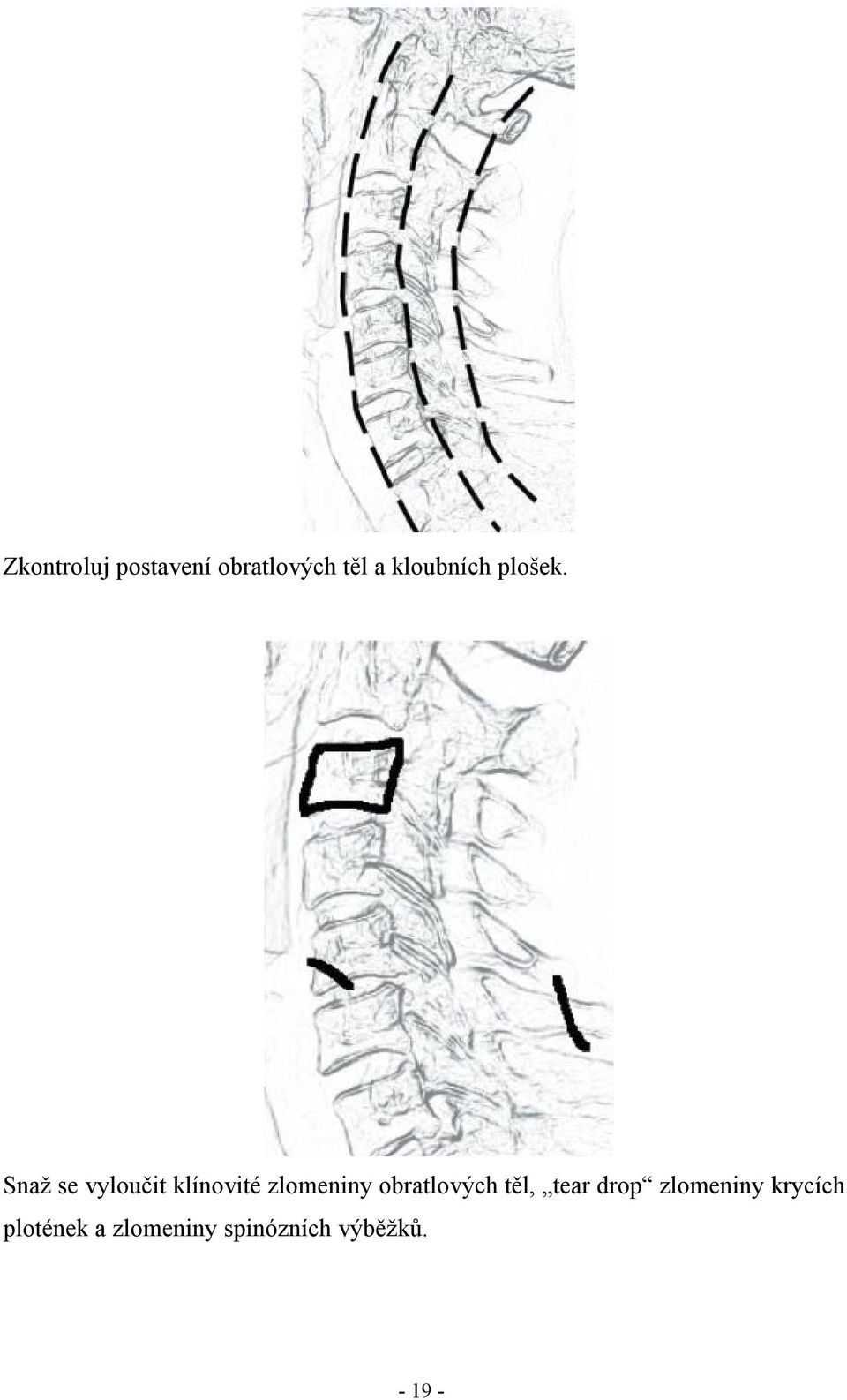 Snaž se vyloučit klínovité zlomeniny