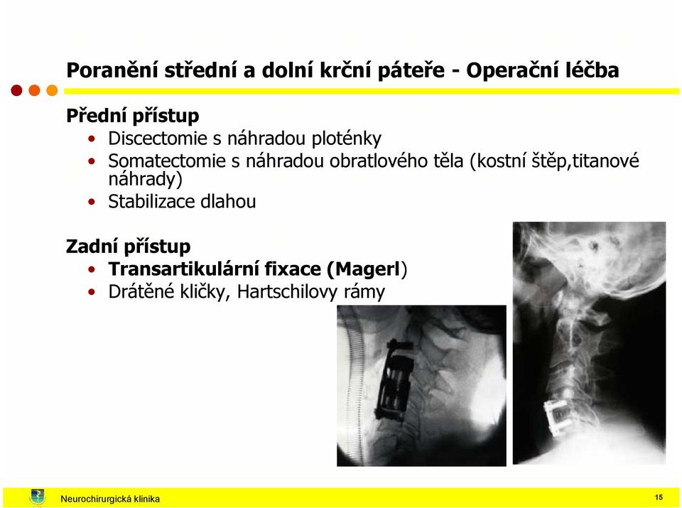 (kostní štěp,titanové náhrady) Stabilizace dlahou Zadní přístup