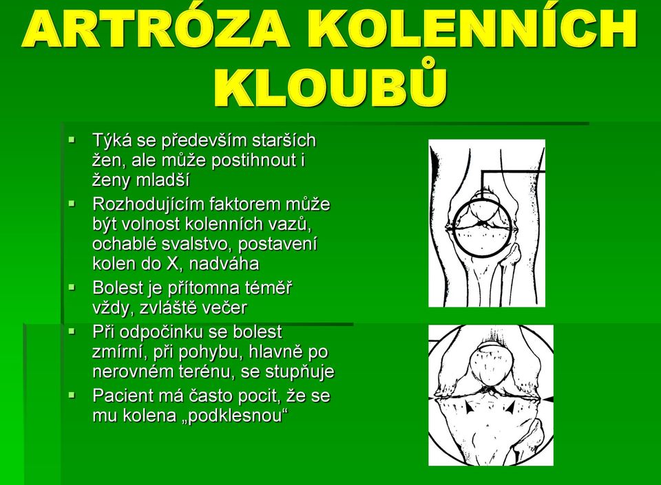 X, nadváha Bolest je přítomna téměř vždy, zvláště večer Při odpočinku se bolest zmírní, při