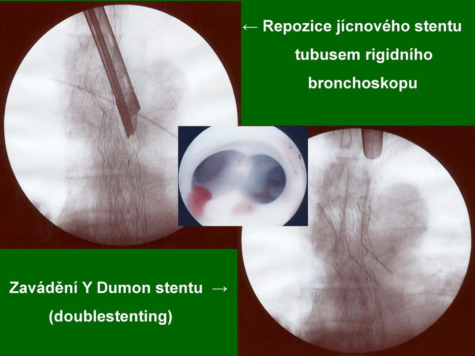 bronchoskopu Zavádění Y