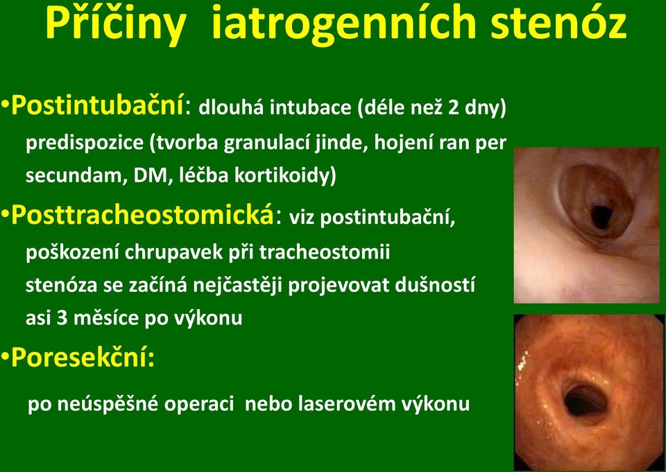 Posttracheostomická: viz postintubační, poškození chrupavek při tracheostomii stenóza se