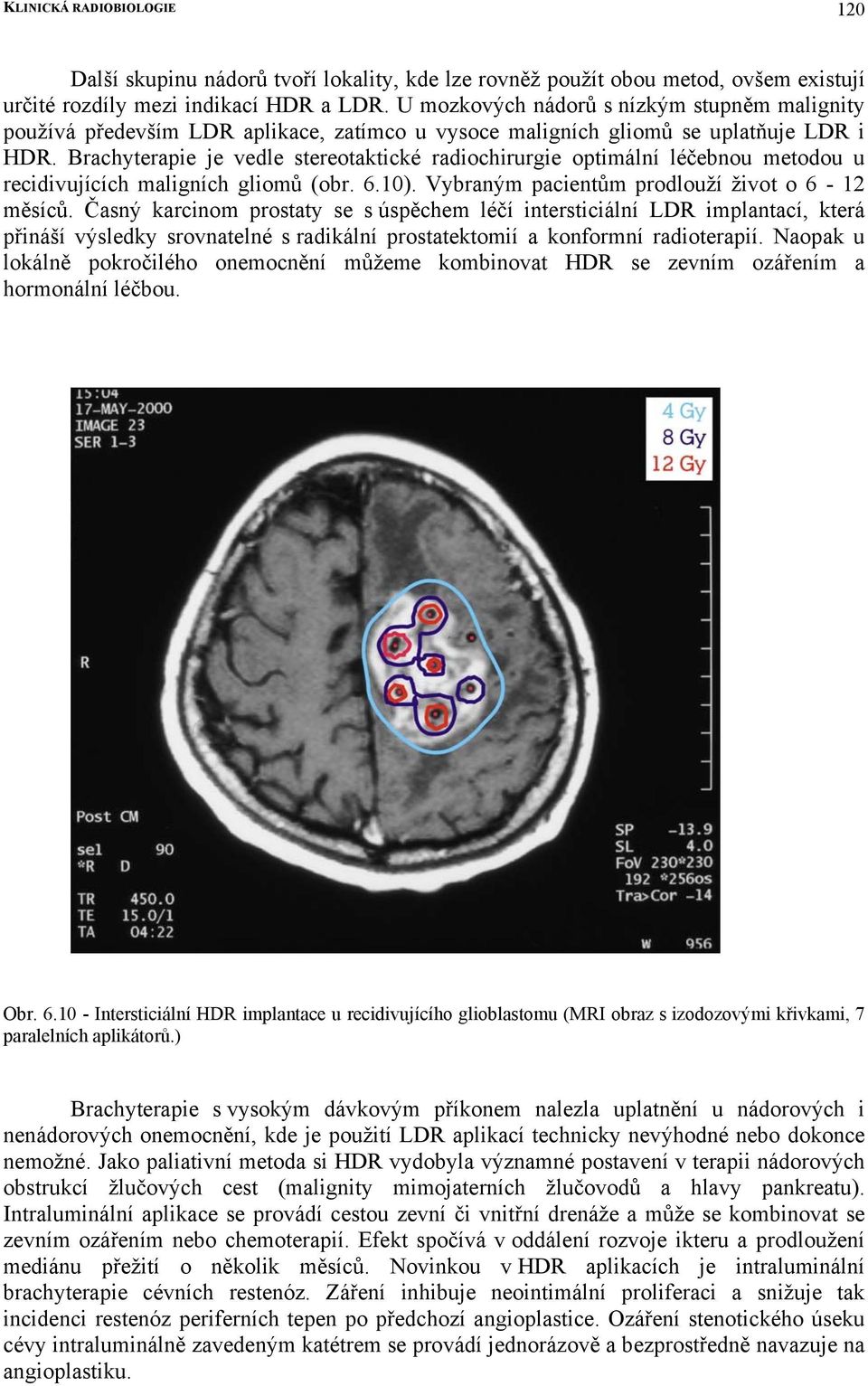 Brachyterapie je vedle stereotaktické radiochirurgie optimální léčebnou metodou u recidivujících maligních gliomů (obr. 6.10). Vybraným pacientům prodlouží život o 6-12 měsíců.