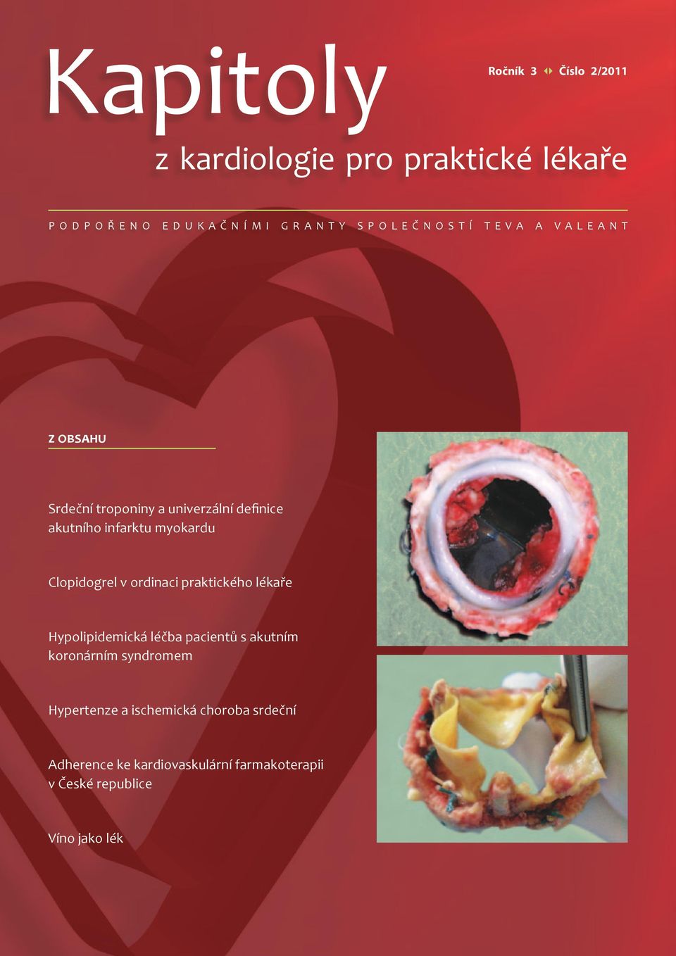 Clopidogrel v ordinaci praktického lékaře Hypolipidemická léčba pacientů s akutním koronárním syndromem