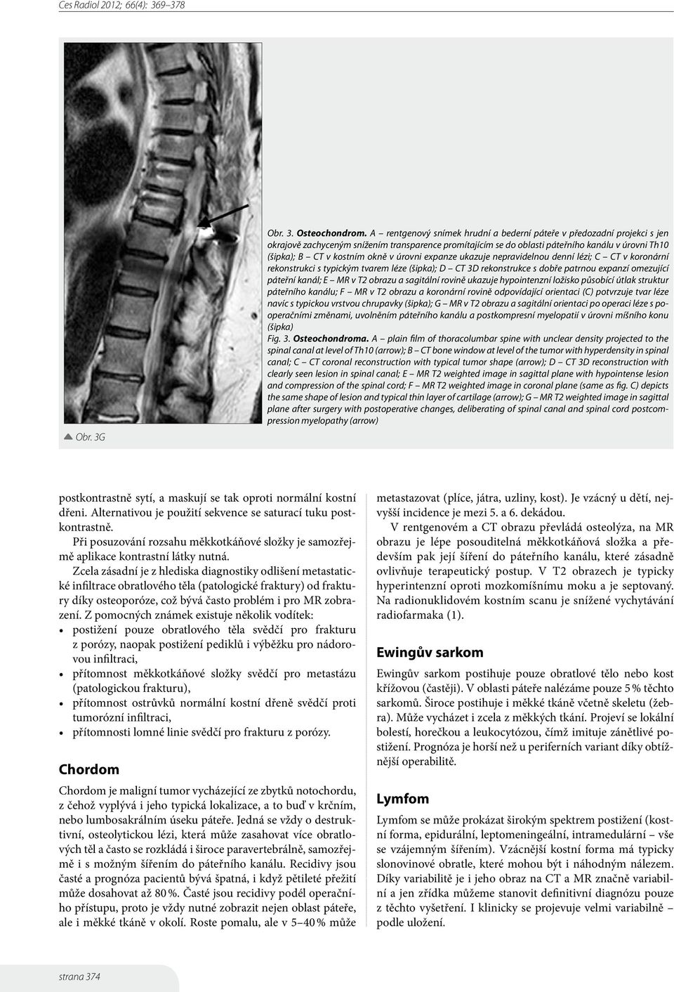 okně v úrovni expanze ukazuje nepravidelnou denní lézi; C CT v koronární rekonstrukci s typickým tvarem léze (šipka); D CT 3D rekonstrukce s dobře patrnou expanzí omezující páteřní kanál; E MR v T2