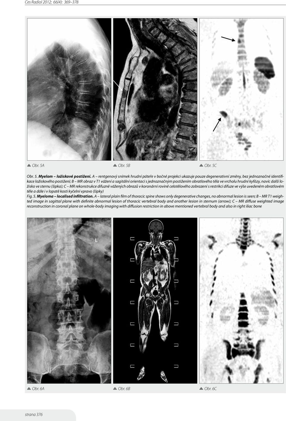 postižením obratlového těla ve vrcholu hrudní kyfózy, navíc další ložisko ve sternu (šipka); C MR rekonstrukce difuzně vážených obrazů v koronární rovině celotělového zobrazení s restrikci difuze ve