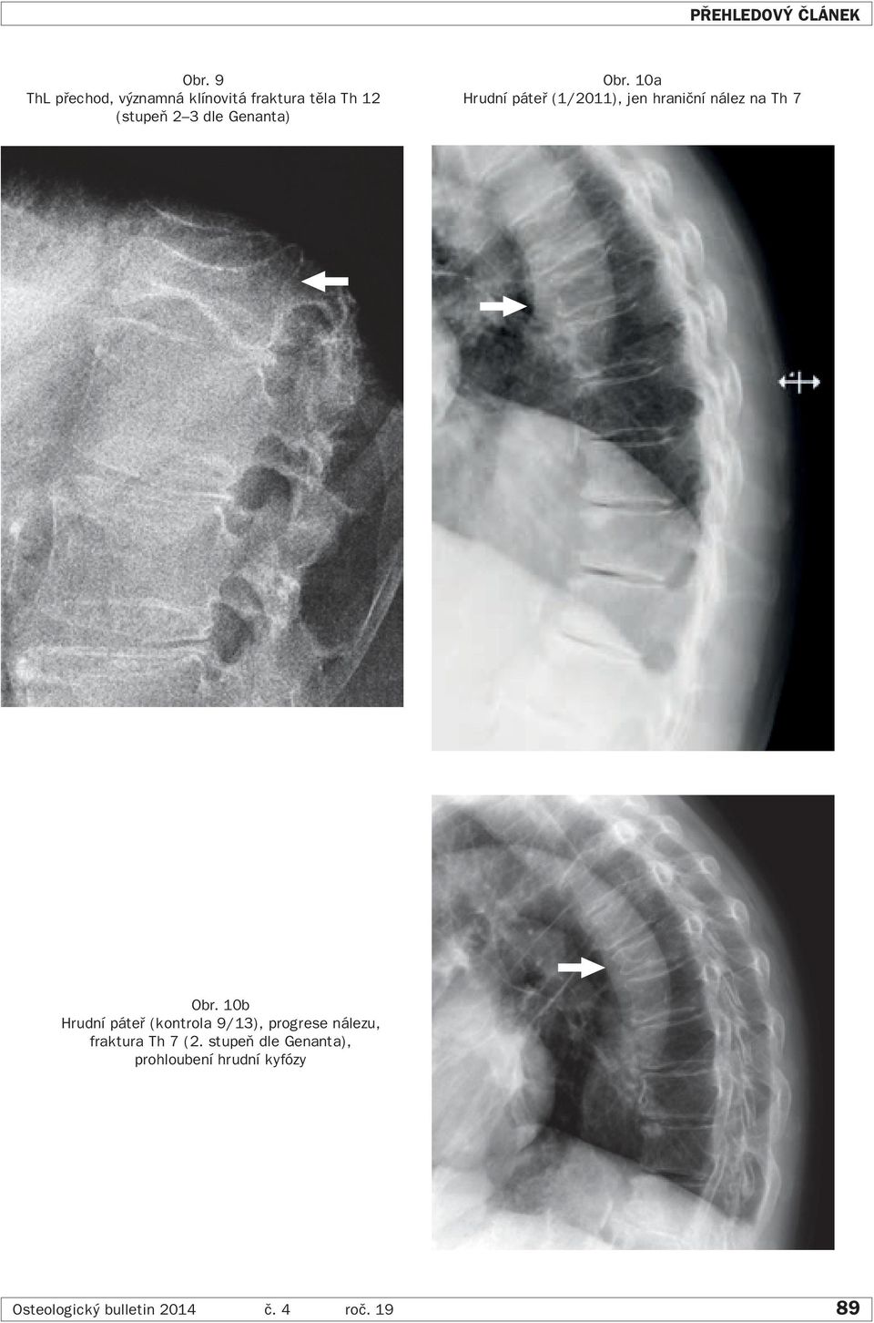 Obr. 10a Hrudní páteř (1/2011), jen hraniční nález na Th 7 Obr.