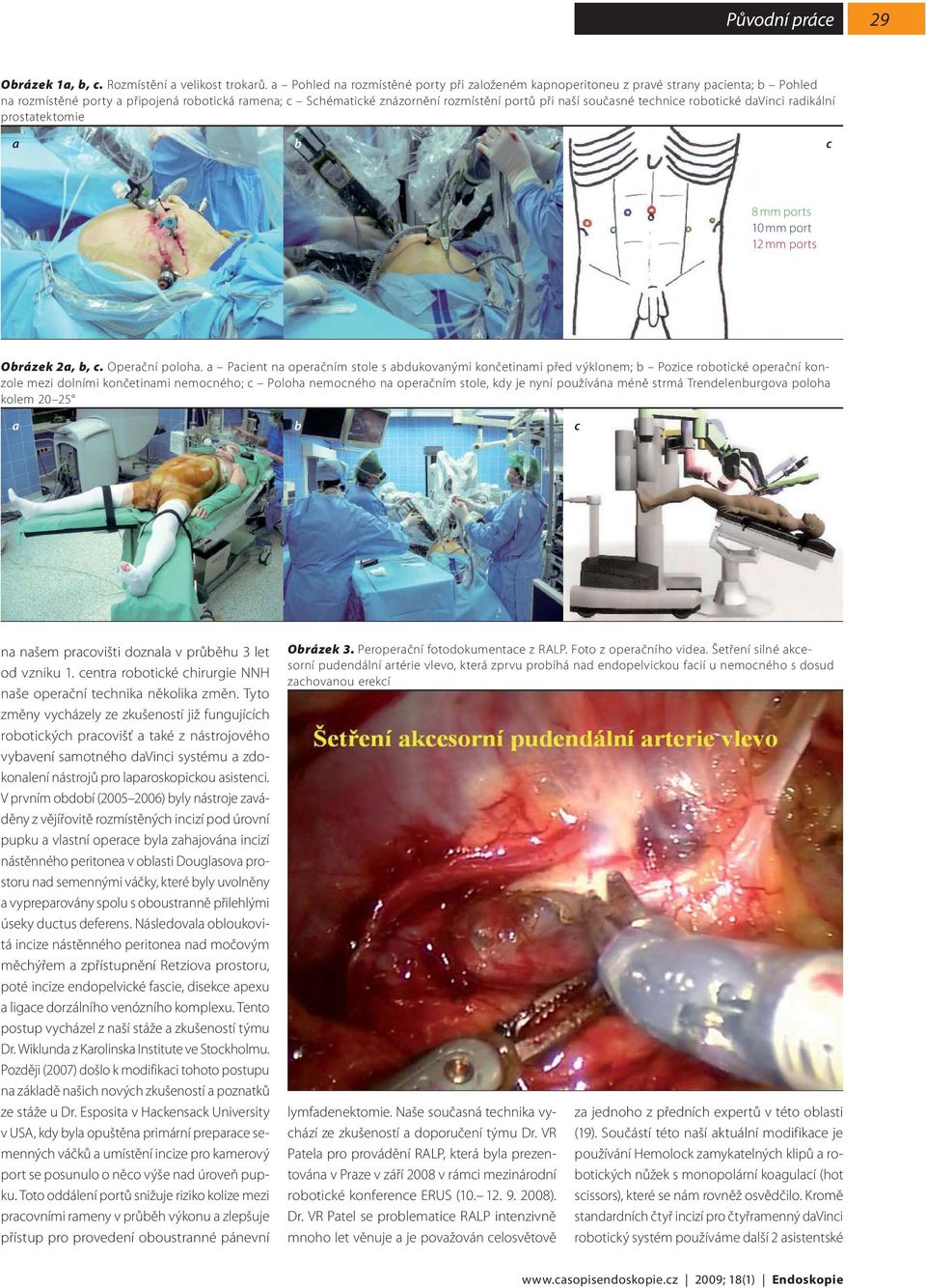 současné technice robotické davinci radikální prostatektomie a b c 8 mm ports 10 mm port 12 mm ports Obrázek 2a, b, c. Operační poloha.