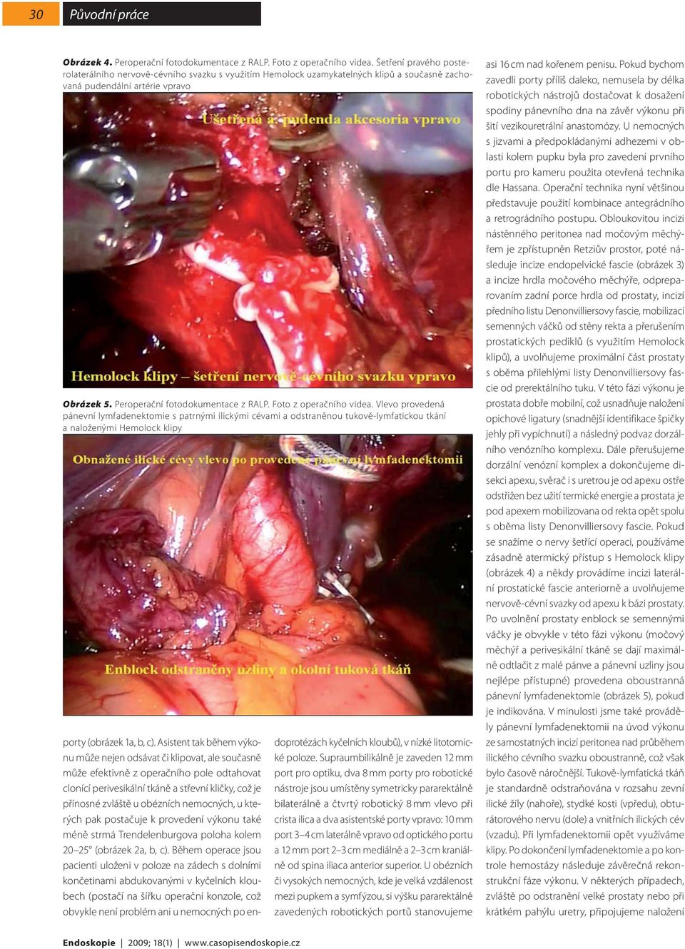 Foto z operačního videa. Vlevo provedená pánevní lymfadenektomie s patrnými ilickými cévami a odstraněnou tukově-lymfatickou tkání a naloženými Hemolock klipy porty (obrázek 1a, b, c).