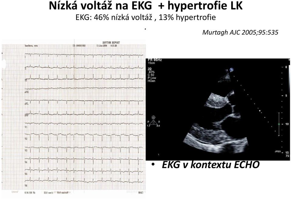 voltáž, 13% hypertrofie.