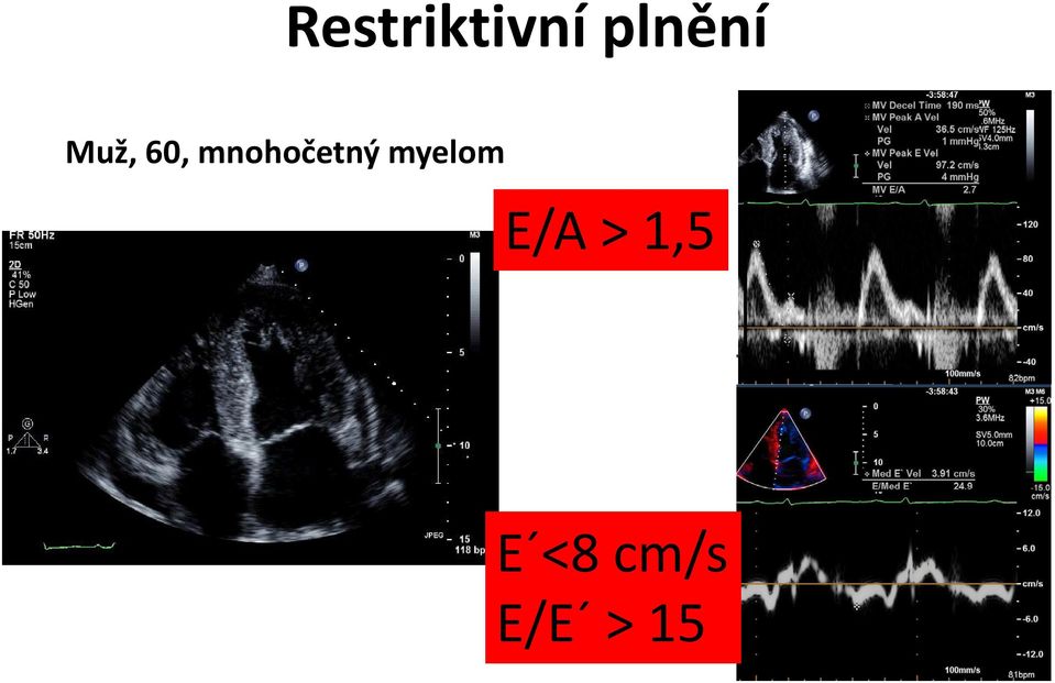 mnohočetný myelom