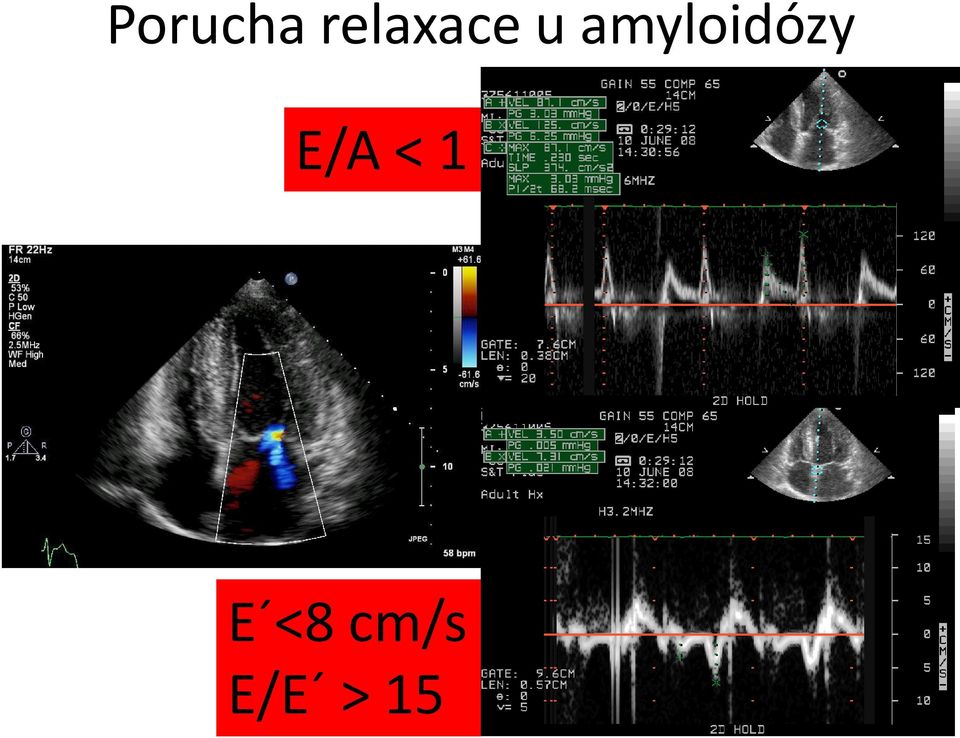 amyloidózy