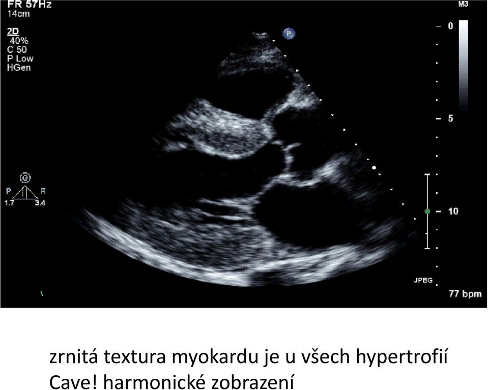 všech hypertrofií