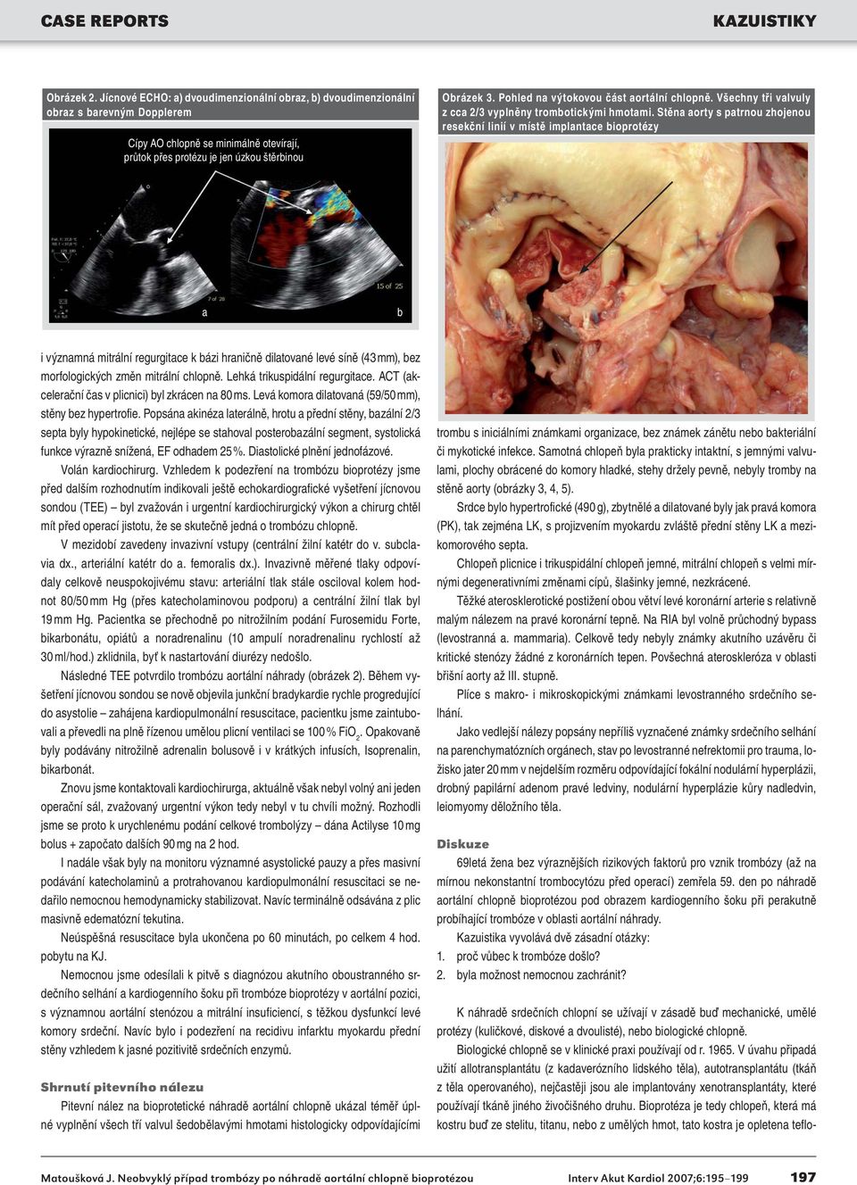 Stěna aorty s patrnou zhojenou resekční linií v místě implantace bioprotézy a b i významná mitrální regurgitace k bázi hraničně dilatované levé síně (43 mm), bez morfologických změn mitrální chlopně.