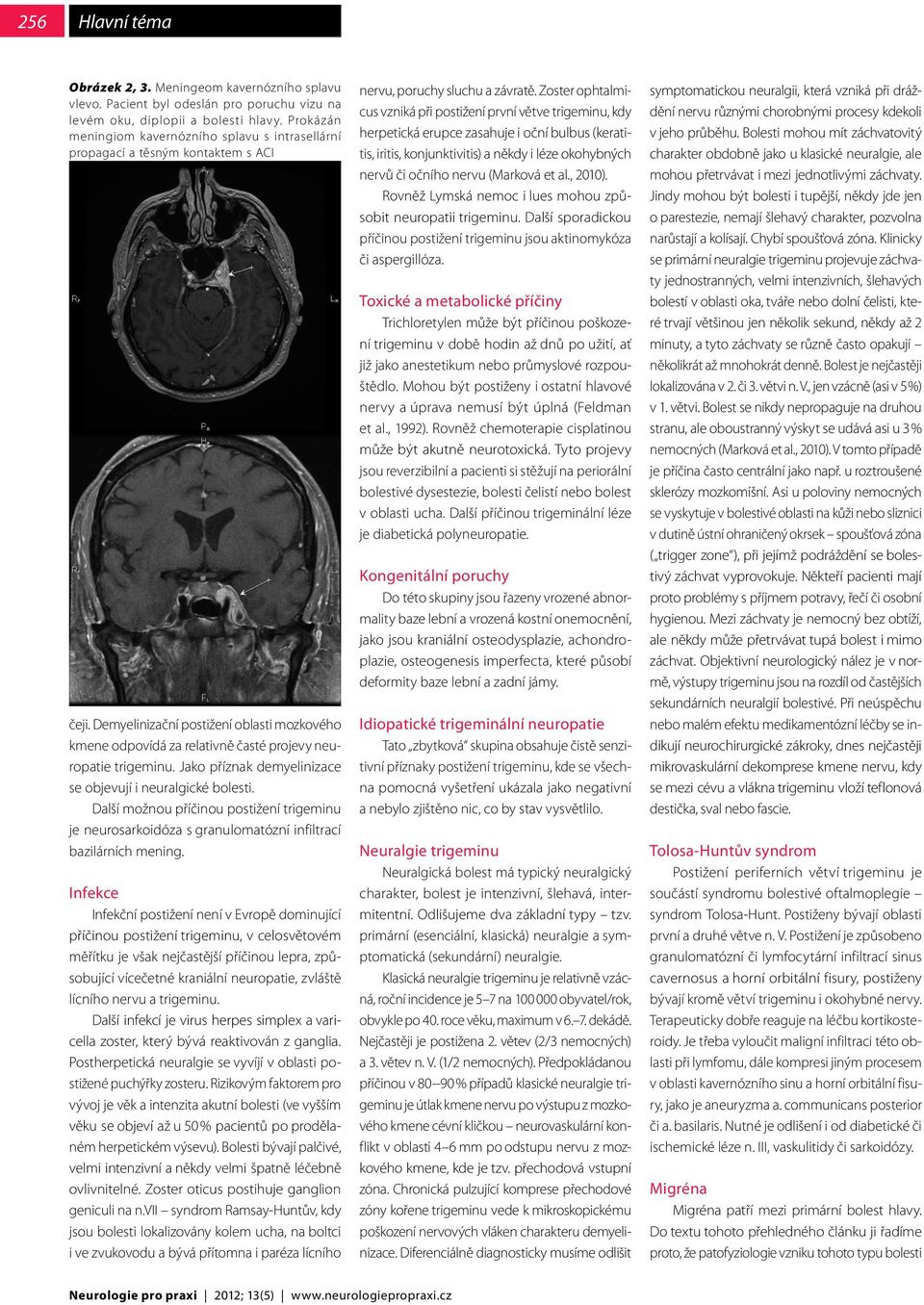 Demyelinizační postižení oblasti mozkového kmene odpovídá za relativně časté projevy neuropatie trigeminu. Jako příznak demyelinizace se objevují i neuralgické bolesti.