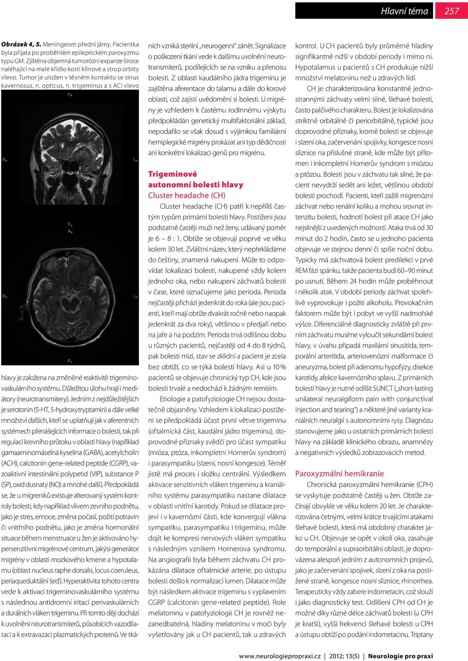 trigeminus a s ACI vlevo hlavy je založena na změněné reaktivitě trigeminovaskulárního systému. Důležitou úlohu hrají i mediátory (neurotransmitery).