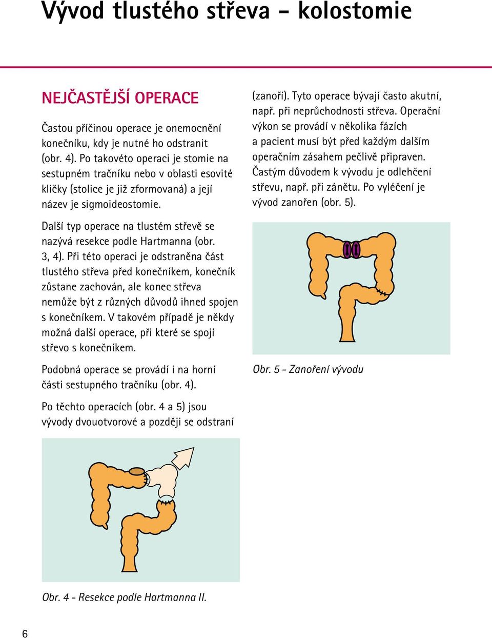 Další typ operace na tlustém střevě se nazývá resekce podle Hartmanna (obr. 3, 4).
