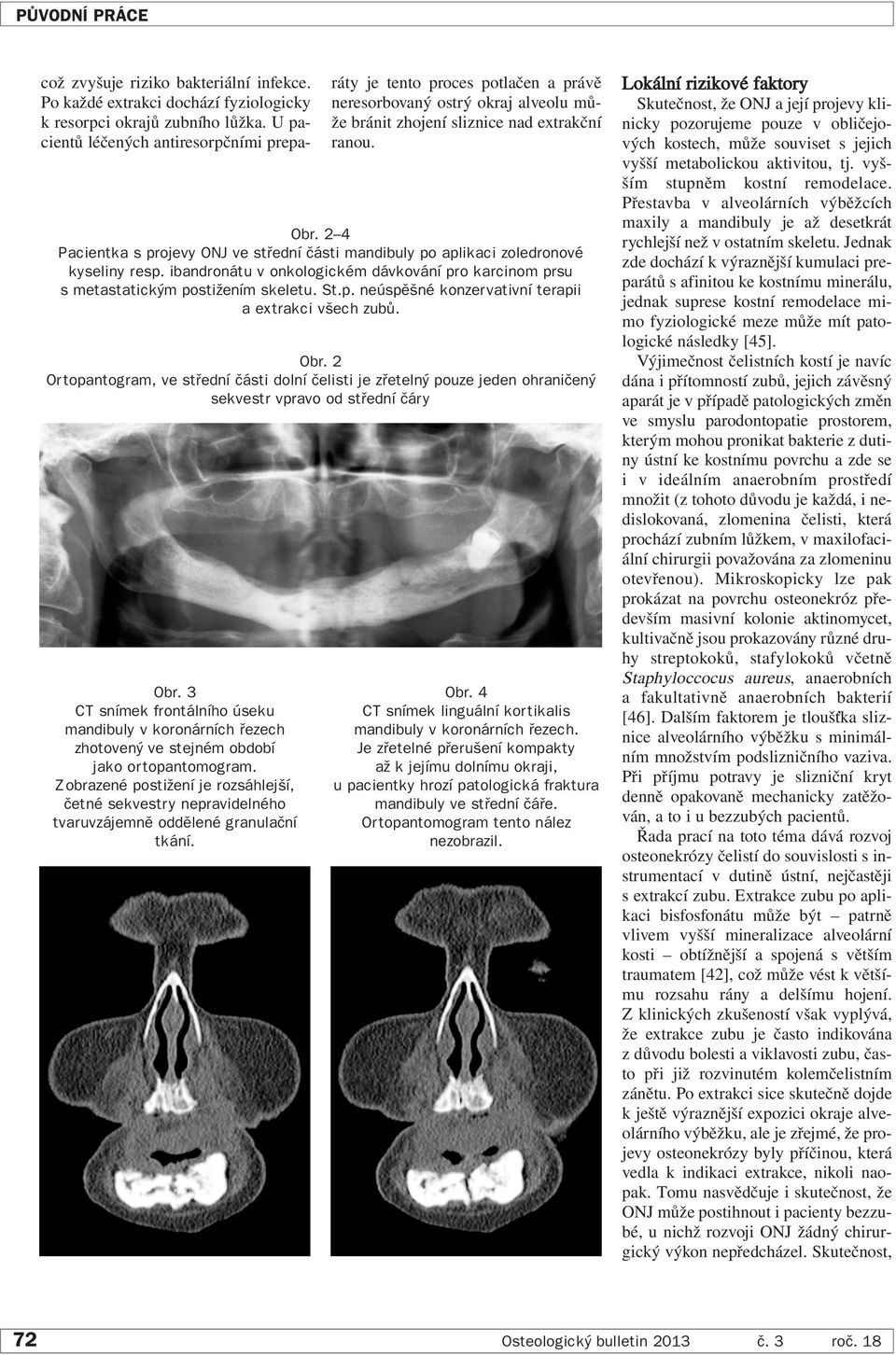 2 4 Pacientka s projevy ONJ ve střední části mandibuly po aplikaci zoledronové kyseliny resp. ibandronátu v onkologickém dávkování pro karcinom prsu s metastatickým postižením skeletu. St.p. neúspěšné konzervativní terapii a extrakci všech zubů.