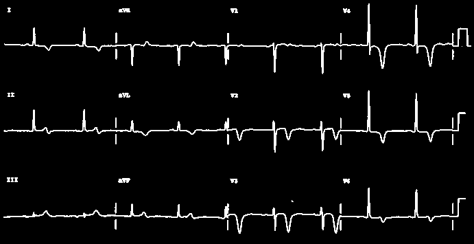 Infarkt non-q Non-Q (není patologický kmit Q),