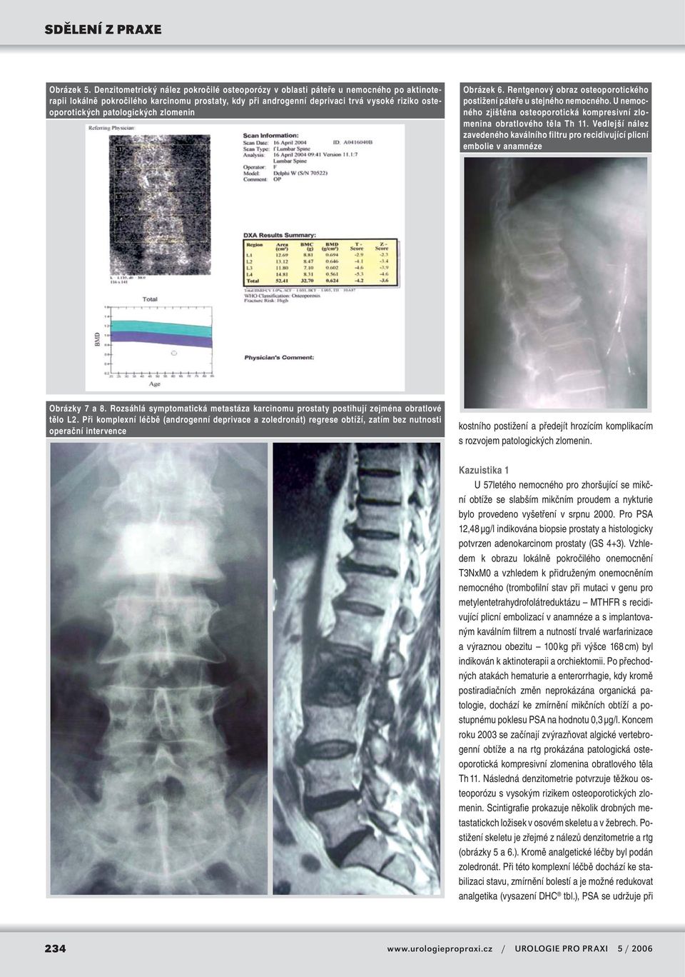 patologických zlomenin Obrázek 6. Rentgenový obraz osteoporotického postižení páteře u stejného nemocného. U nemocného zjištěna osteoporotická kompresivní zlomenina obratlového těla Th 11.