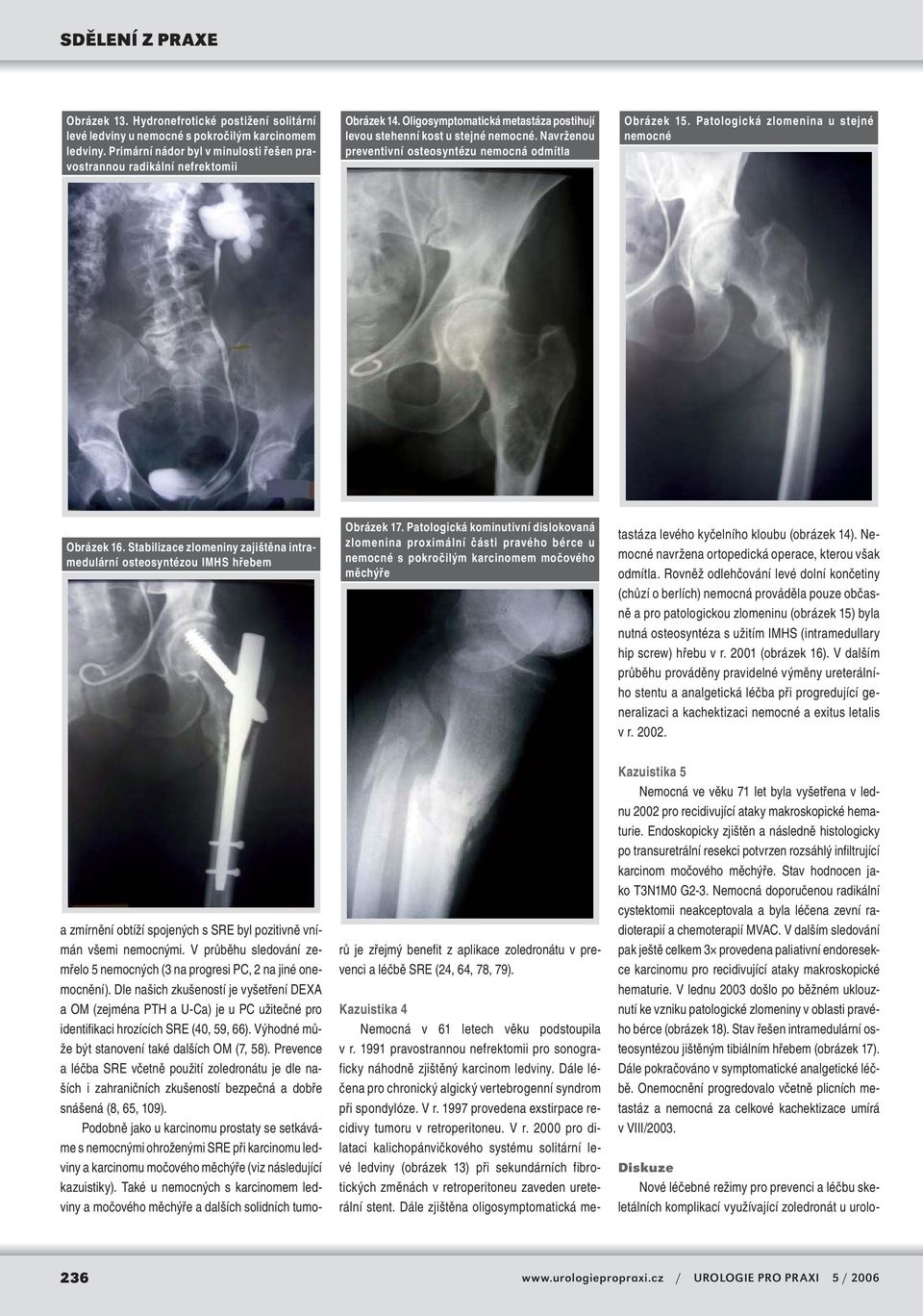 Stabilizace zlomeniny zajištěna intramedulární osteosyntézou IMHS hřebem Obrázek 17.