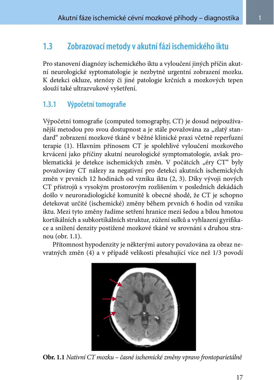 K detekci okluze, stenózy či jiné patologie krčních a mozkových tepen slouží také ultrazvukové vyšetření. 1.3.