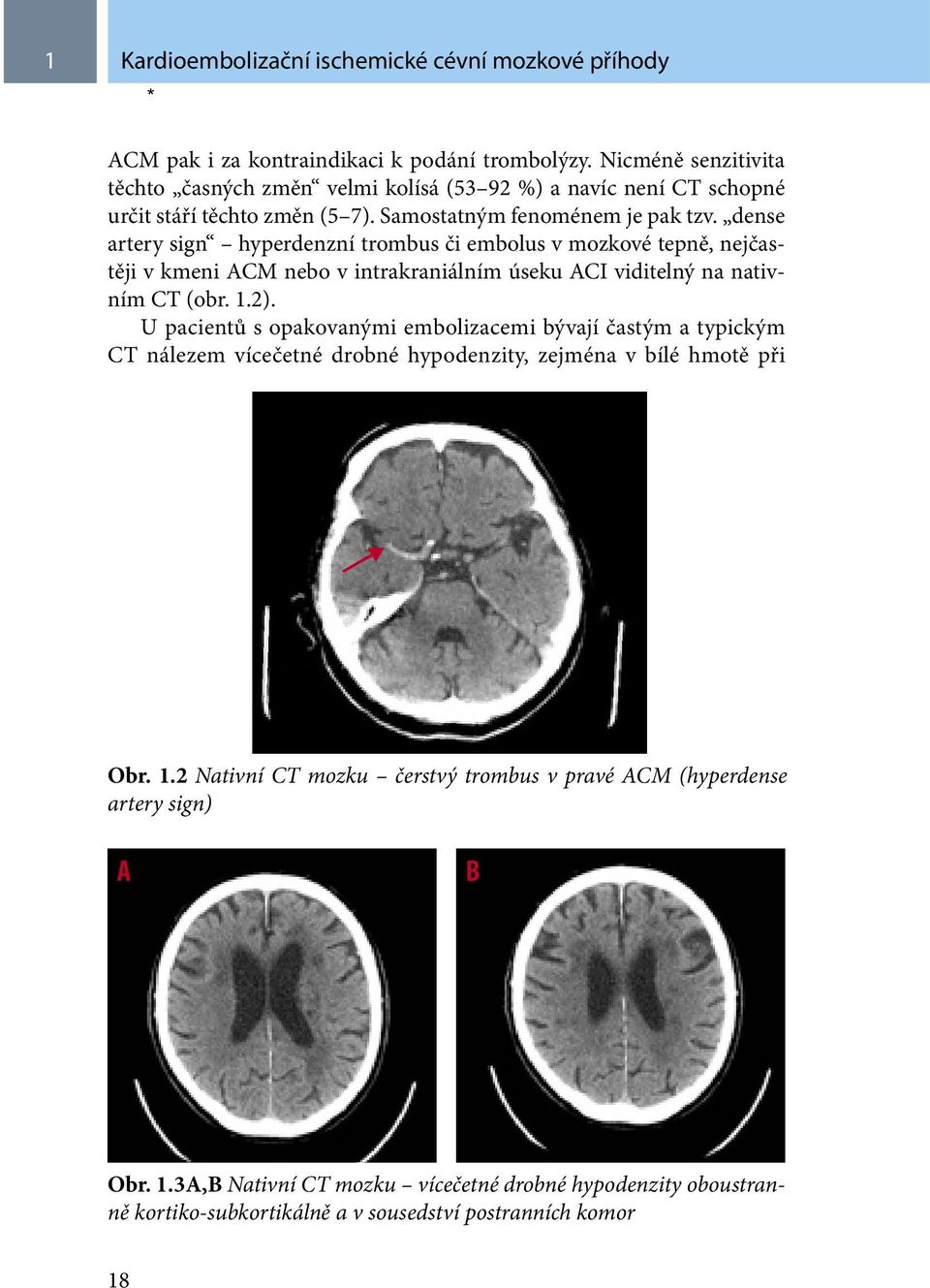 dense artery sign hyperdenzní trombus či embolus v mozkové tepně, nejčastěji v kmeni ACM nebo v intrakraniálním úseku ACI viditelný na nativním CT (obr. 1.2).