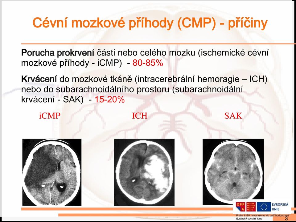 Krvácení do mozkové tkáně (intracerebrální hemoragie ICH) nebo do