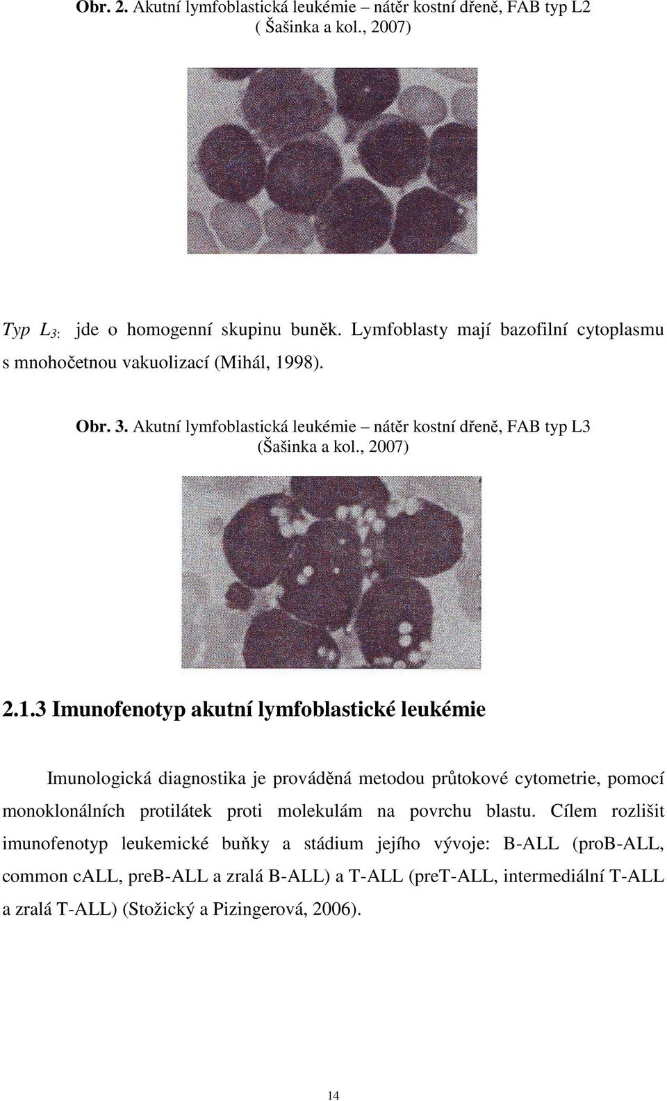 98). Obr. 3. Akutní lymfoblastická leukémie nátěr kostní dřeně, FAB typ L3 (Šašinka a kol., 2007) 2.1.