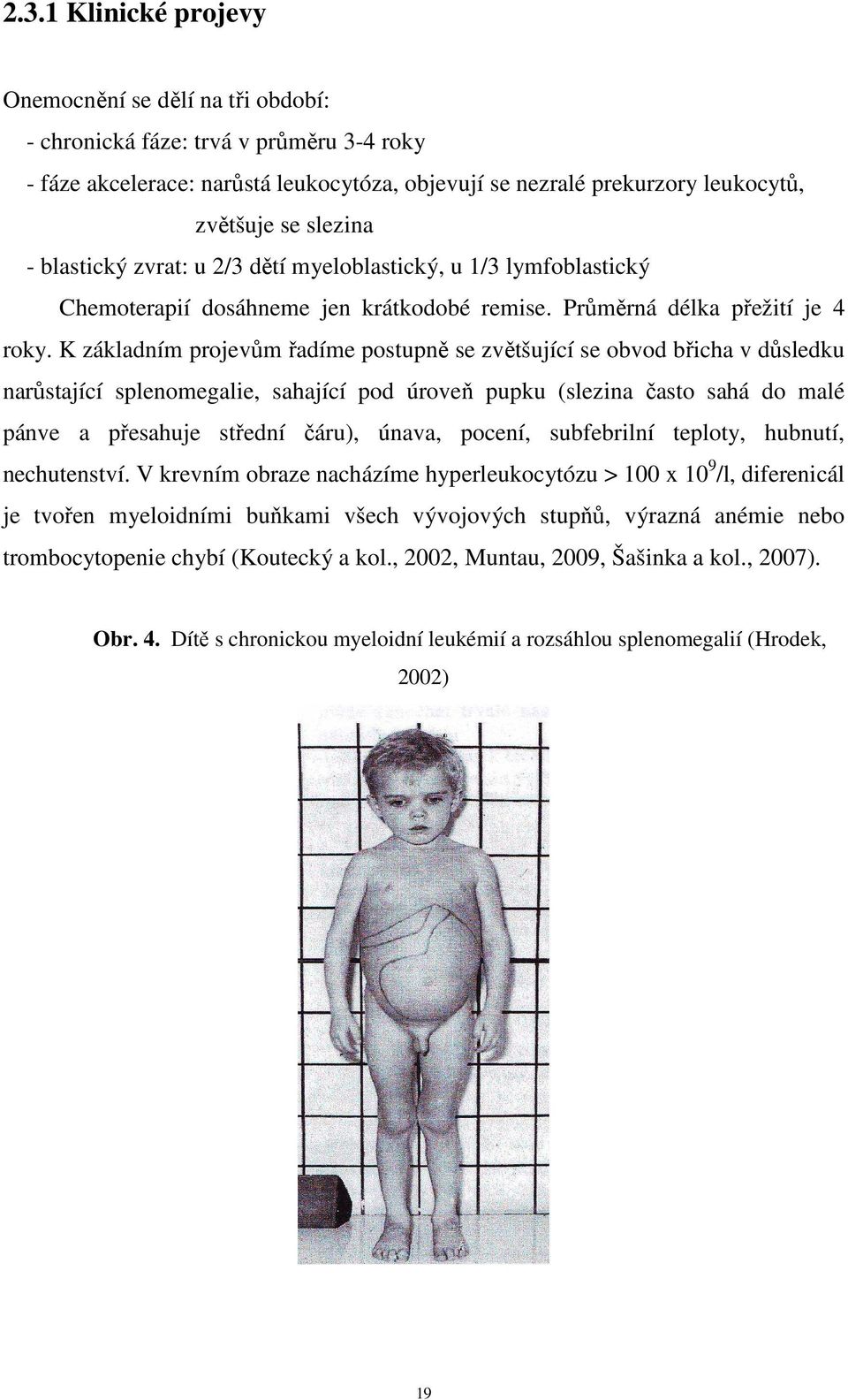 K základním projevům řadíme postupně se zvětšující se obvod břicha v důsledku narůstající splenomegalie, sahající pod úroveň pupku (slezina často sahá do malé pánve a přesahuje střední čáru), únava,