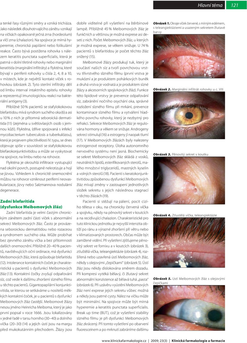 Často bývá postižena rohovka s nálezem keratitis punctata superficialis, která je patrná v dolní třetině rohovky nebo marginální keratitida (marginální infiltráty) a flykténa, které bývají v