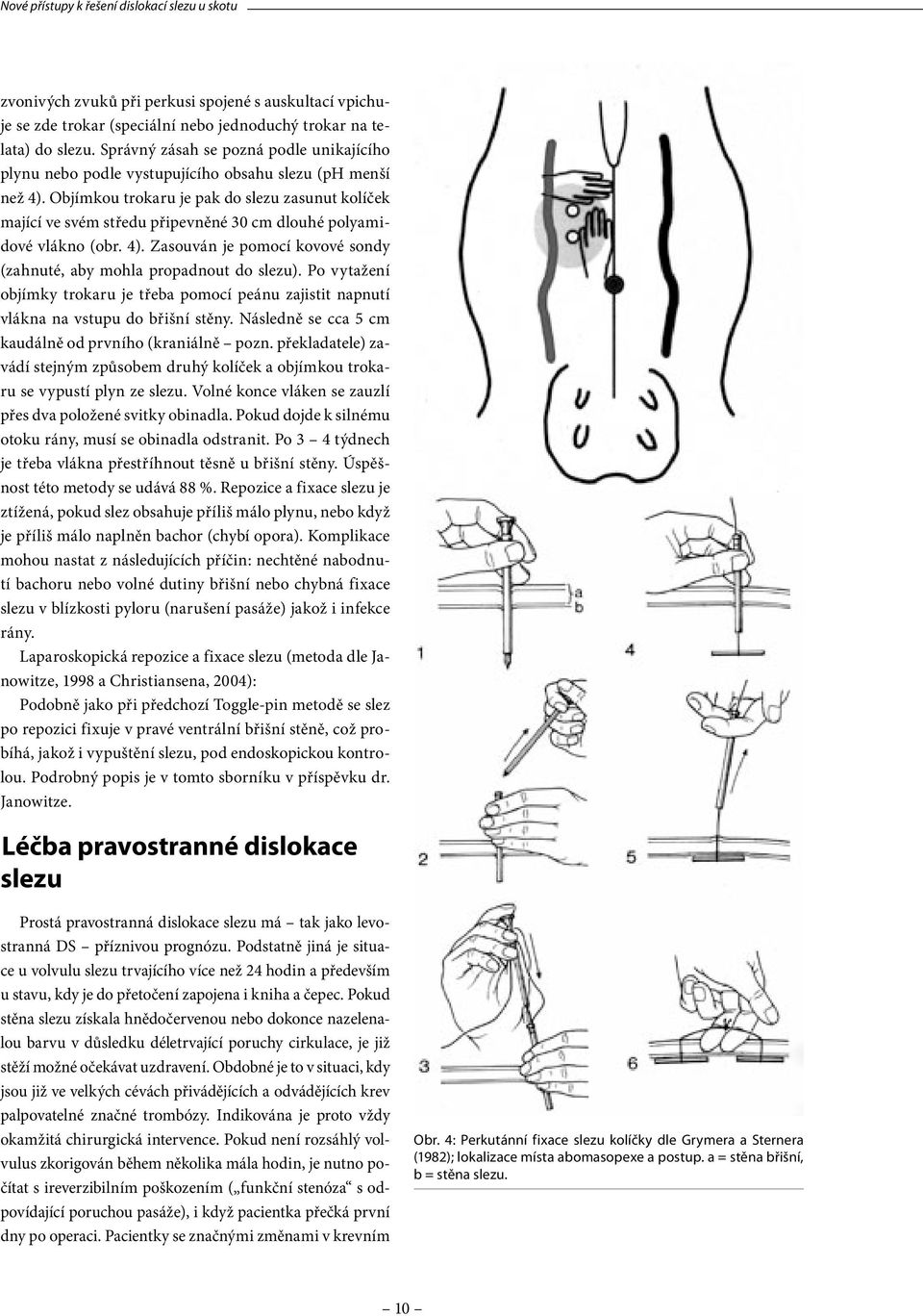 Objímkou trokaru je pak do slezu zasunut kolíček mající ve svém středu připevněné 30 cm dlouhé polyamidové vlákno (obr. 4). Zasouván je pomocí kovové sondy (zahnuté, aby mohla propadnout do slezu).