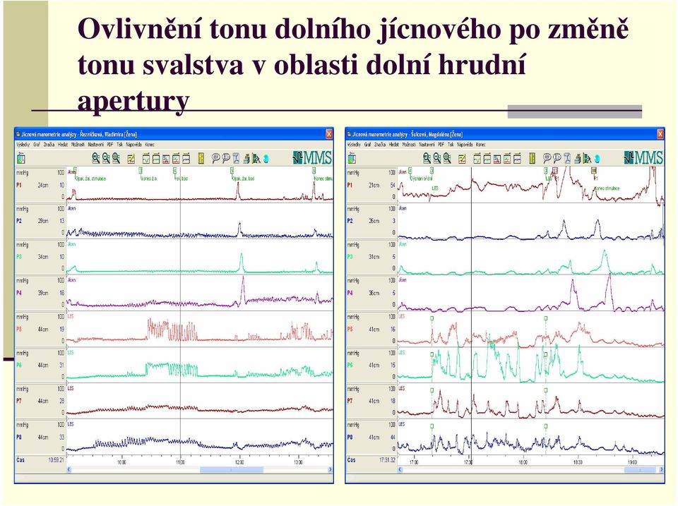 změně tonu svalstva v