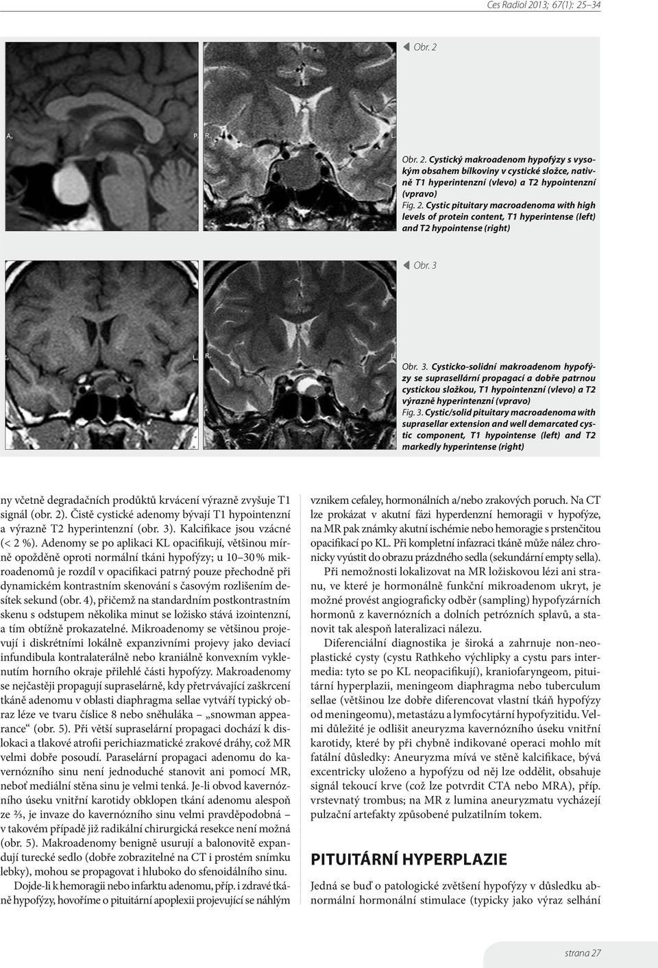Cysticko-solidní makroadenom hypofýzy se suprasellární propagací a dobře patrnou cystickou složkou, T1 hypointenzní (vlevo) a T2 výrazně hyperintenzní (vpravo) Fig. 3.