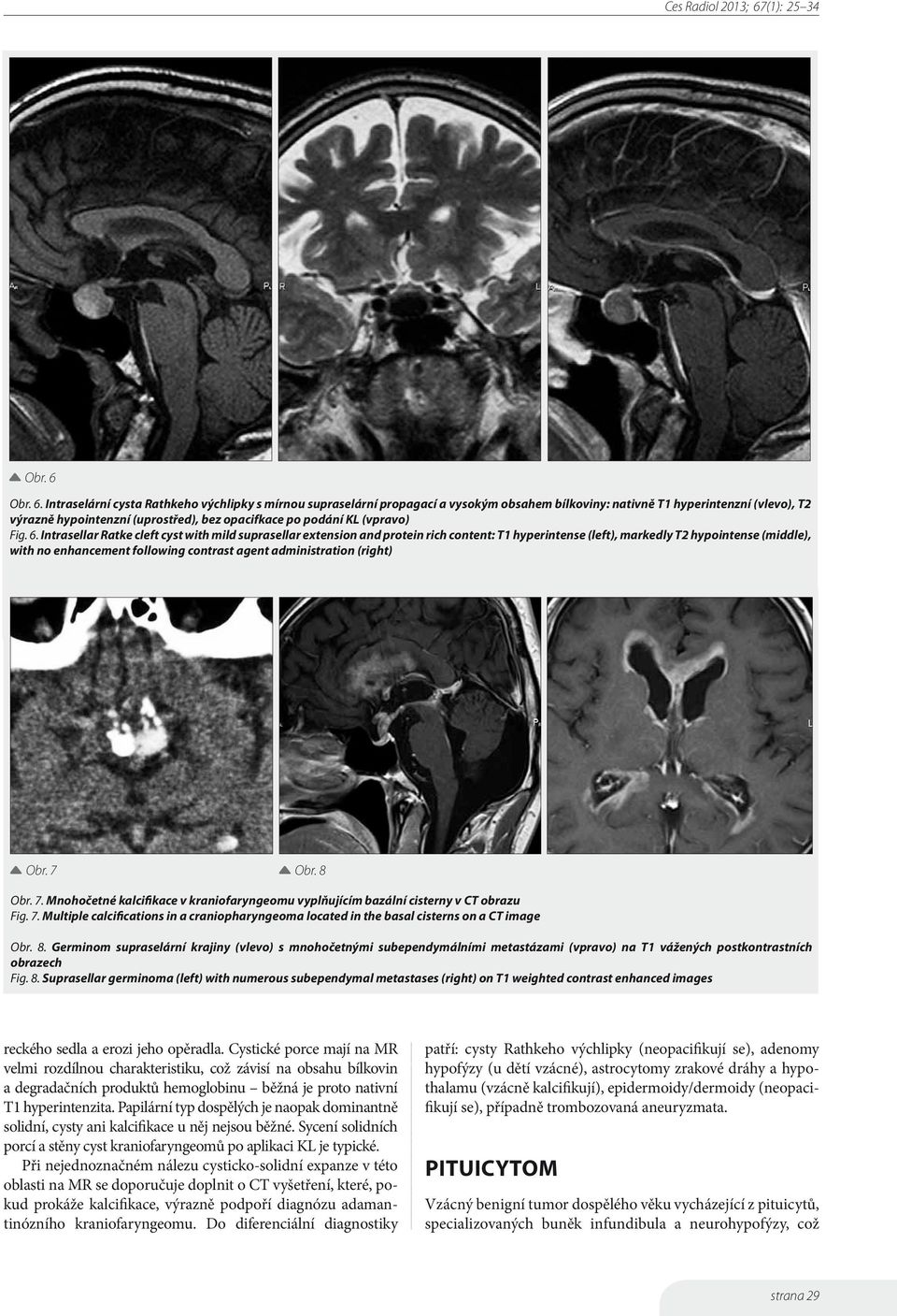 Intraselární cysta Rathkeho výchlipky s mírnou supraselární propagací a vysokým obsahem bílkoviny: nativně T1 hyperintenzní (vlevo), T2 výrazně hypointenzní (uprostřed), bez opacifkace po podání KL