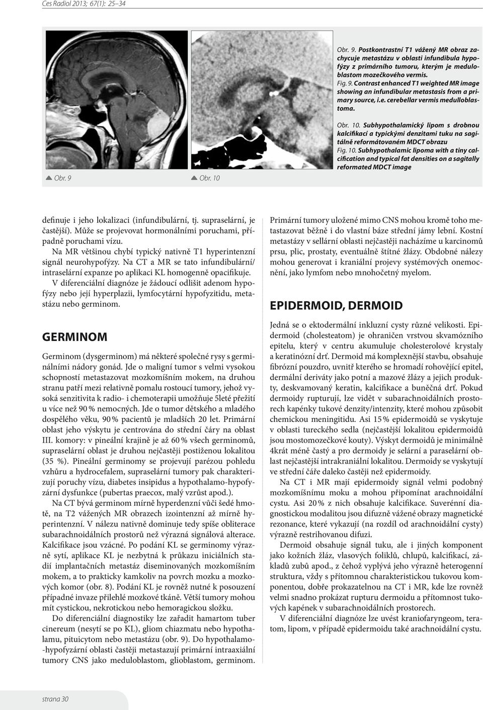 Obr. 10. Subhypothalamický lipom s drobnou kalcifikací a typickými denzitami tuku na sagitálně reformátovaném MDCT obrazu Fig. 10. Subhypothalamic lipoma with a tiny calcification and typical fat densities on a sagitally reformated MDCT image definuje i jeho lokalizaci (infundibulární, tj.