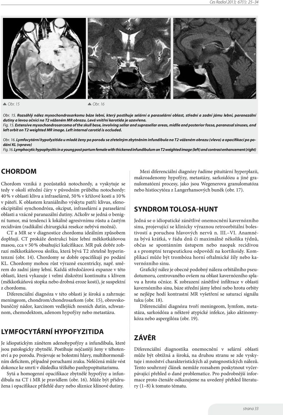 Extensive myxochondrosarcoma of the skull base, involving sellar and suprasellar areas, midlle and posterior fossa, paranasal sinuses, and left orbit on T2 weighted MR image.