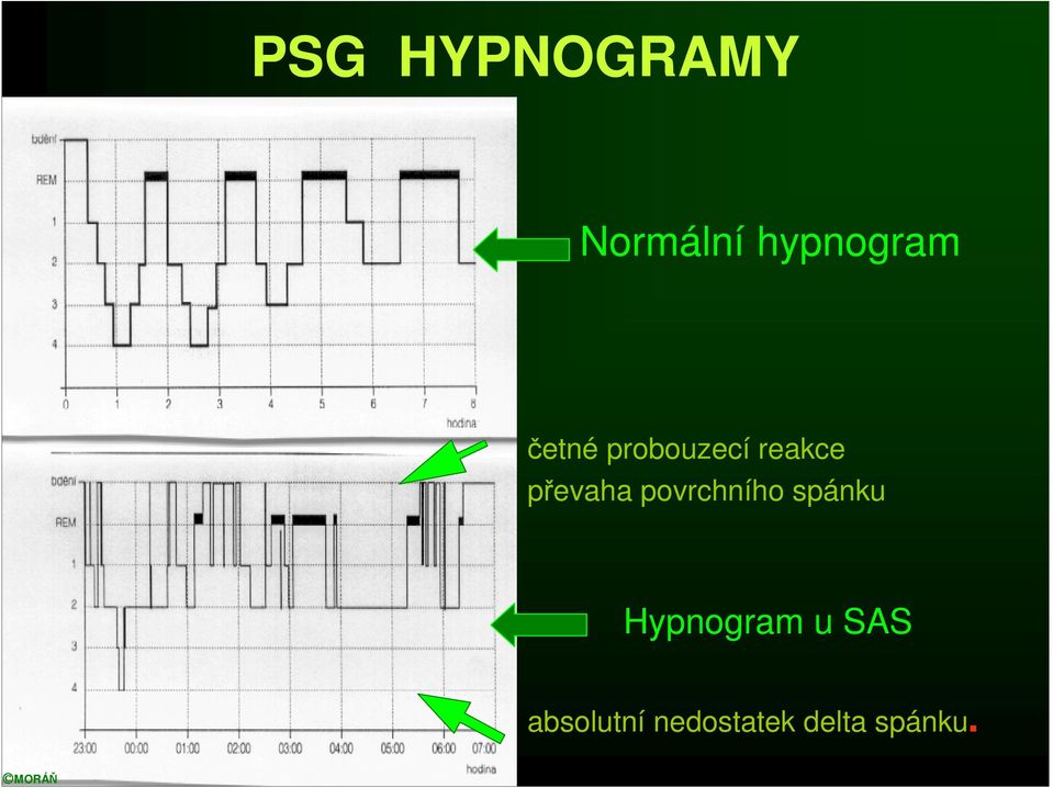 povrchního spánku Hypnogram u SAS