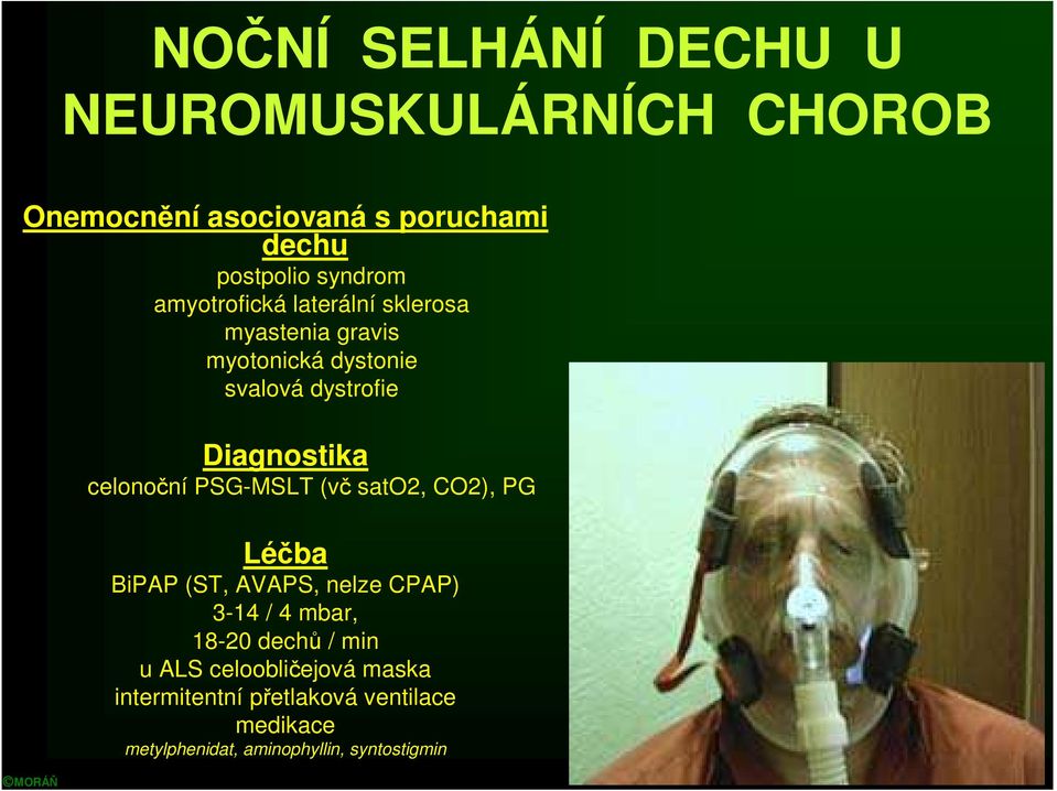 celonoční PSG-MSLT (vč sato2, CO2), PG Léčba BiPAP (ST, AVAPS, nelze CPAP) 3-14 / 4 mbar, 18-20 dechů /