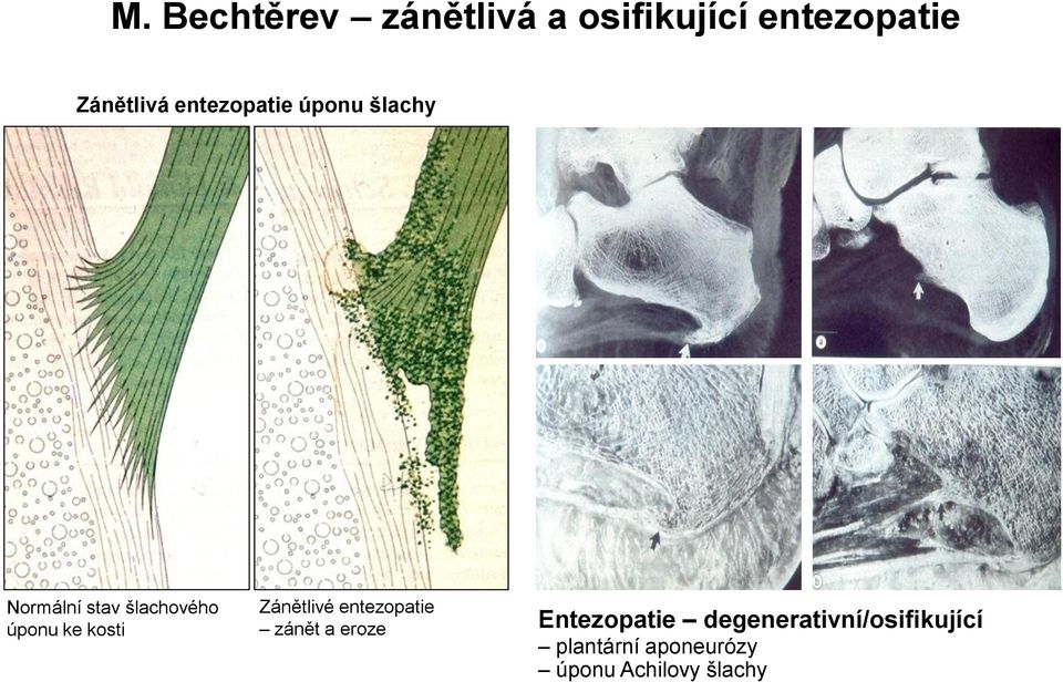 kosti Zánětlivé entezopatie zánět a eroze Entezopatie