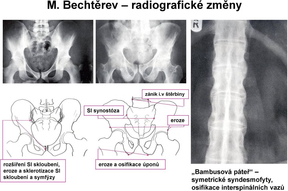 eroze a sklerotizace SI skloubení a symfýzy eroze a