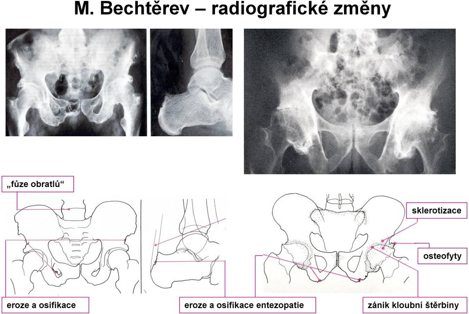 osteofyty eroze a osifikace eroze