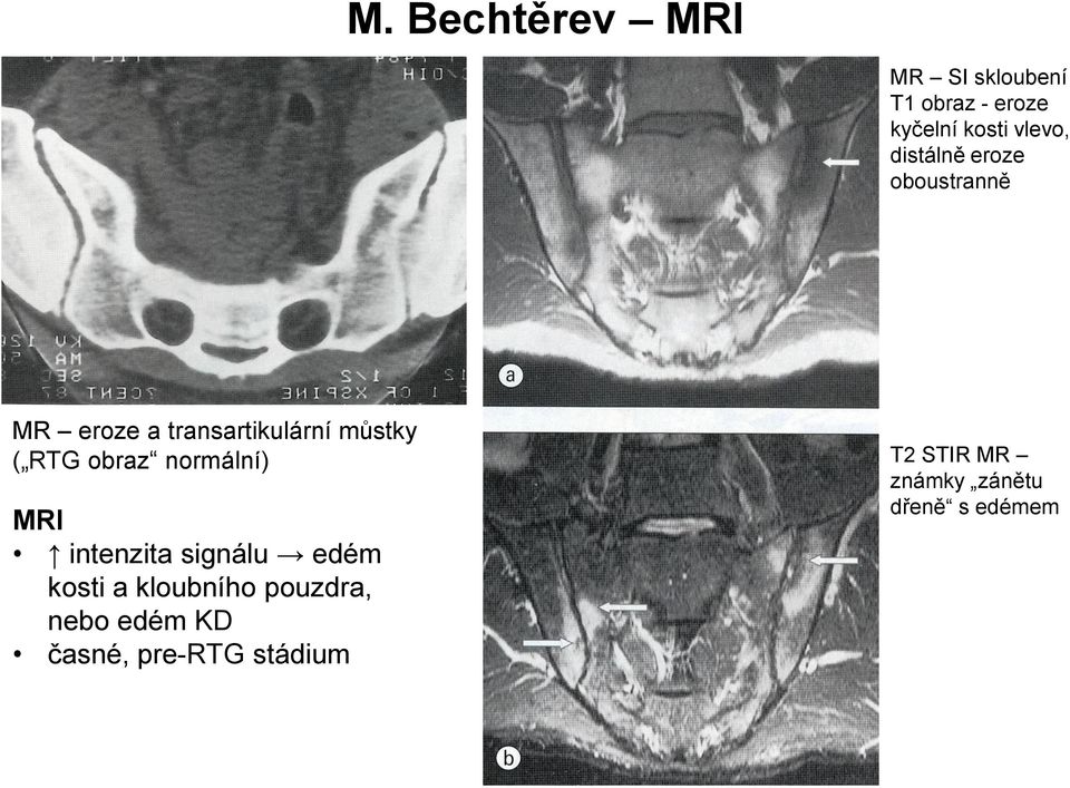 obraz normální) MRI intenzita signálu edém kosti a kloubního pouzdra,