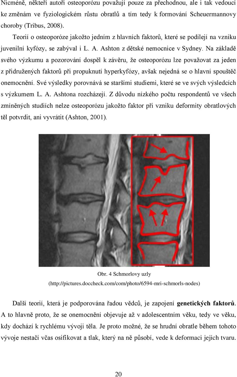 Na základě svého výzkumu a pozorování dospěl k závěru, že osteoporózu lze považovat za jeden z přidružených faktorů při propuknutí hyperkyfózy, avšak nejedná se o hlavní spouštěč onemocnění.