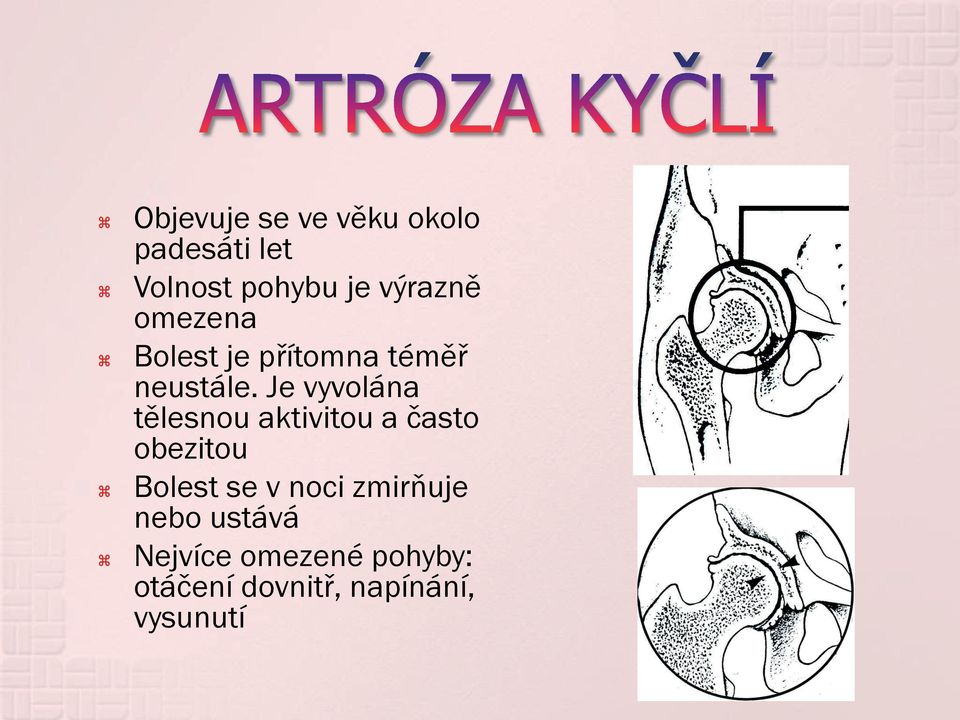 Je vyvolána tělesnou aktivitou a často obezitou Bolest se v