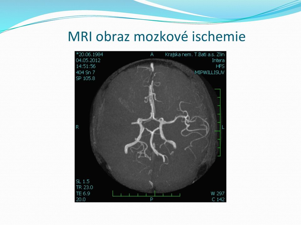 ischemie