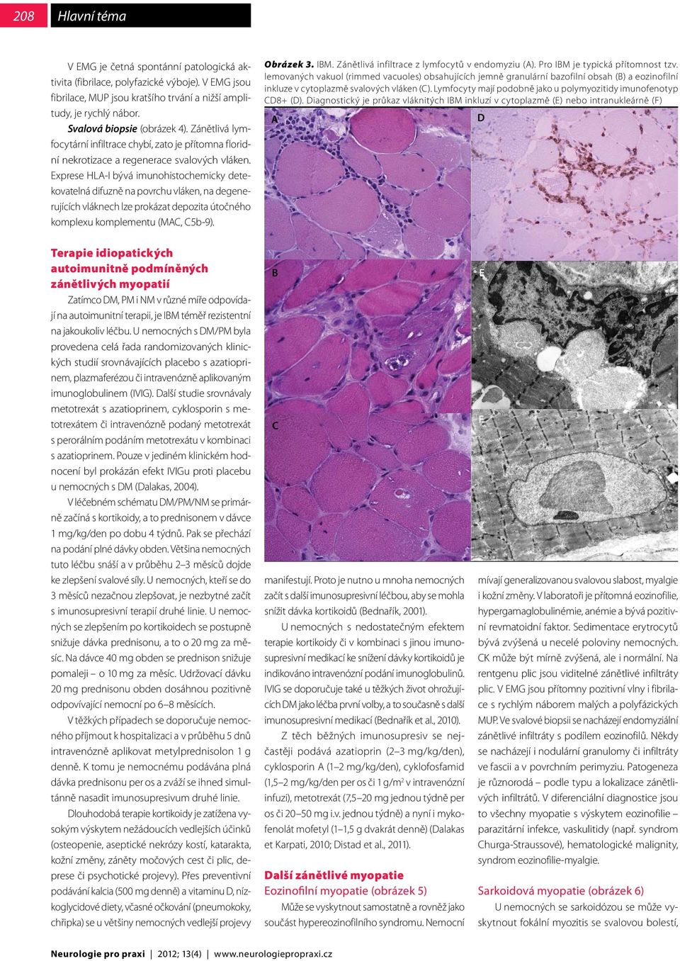 Exprese HLA-I bývá imunohistochemicky detekovatelná difuzně na povrchu vláken, na degenerujících vláknech lze prokázat depozita útočného komplexu komplementu (MAC, C5b-9). Obrázek 3. IBM.